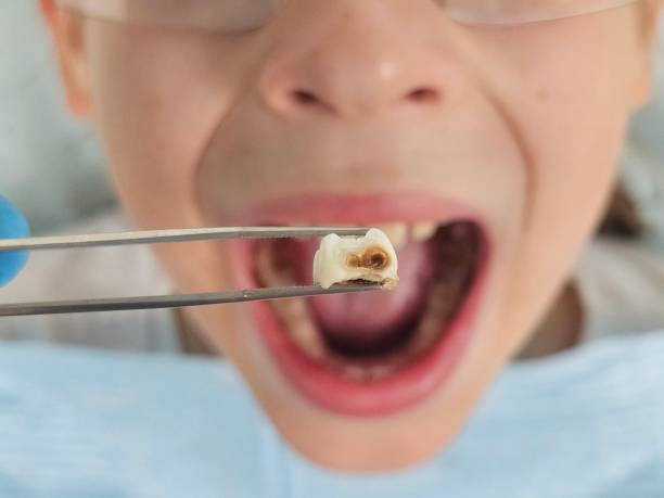 Best Tooth Infection Emergency Dentist  in Longboat Key, FL